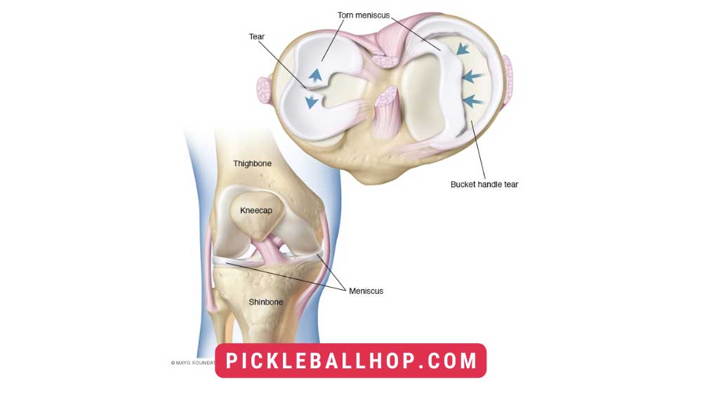 Can I Play Pickleball With A Torn Meniscus